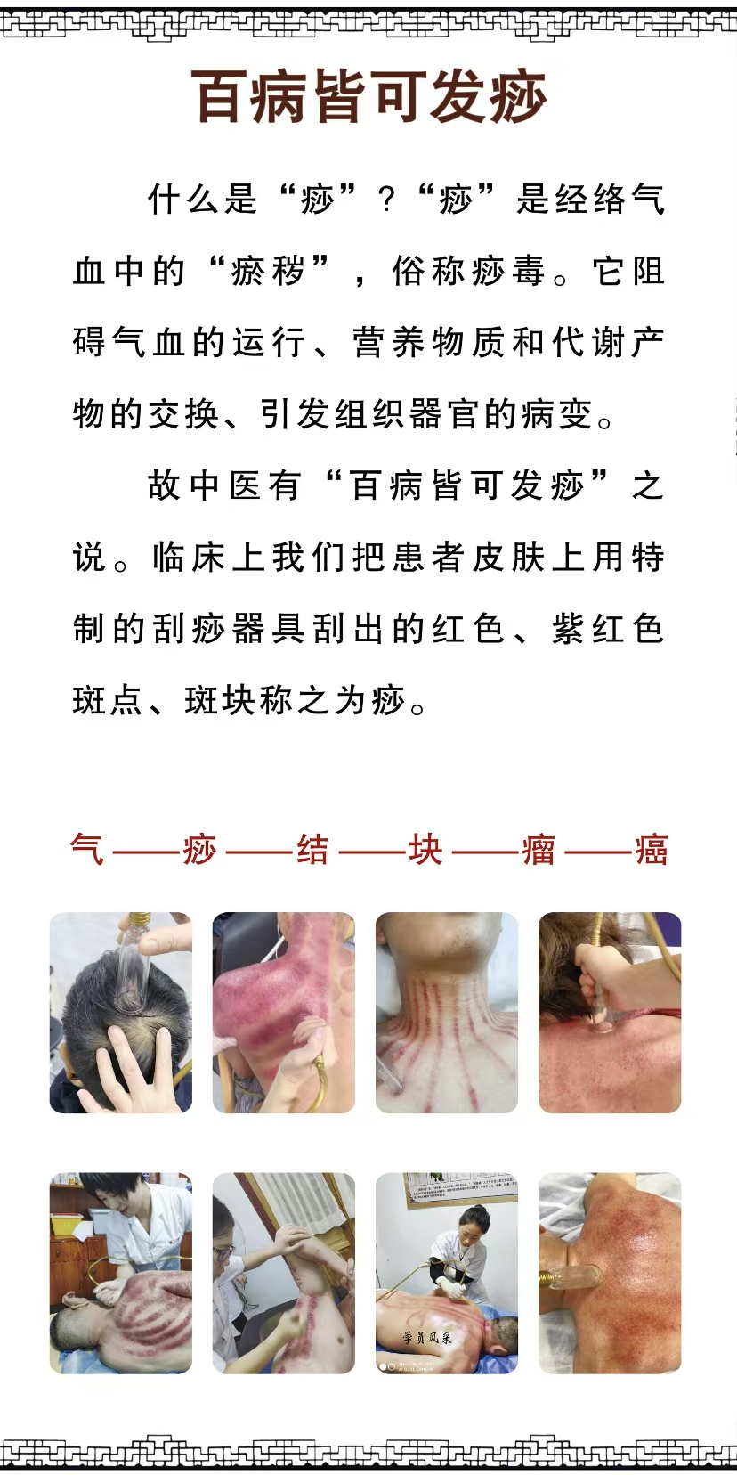百病皆可發痧